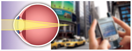 Astigmatism